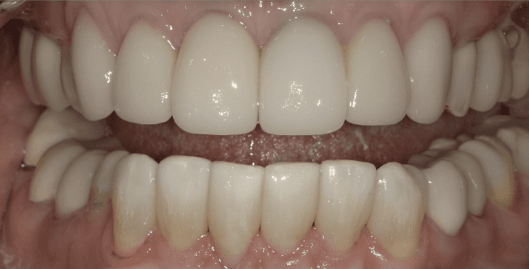 medium_after-case-10