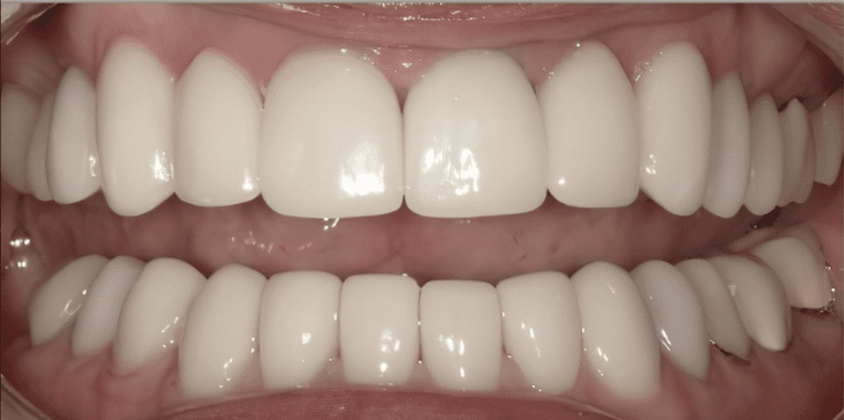 medium_after-case-11