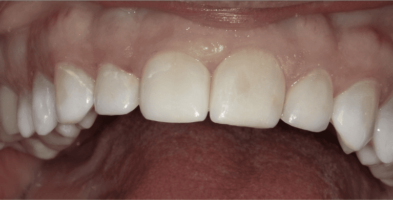 medium_after-case-12