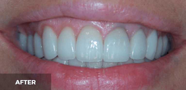 medium_after-case-14