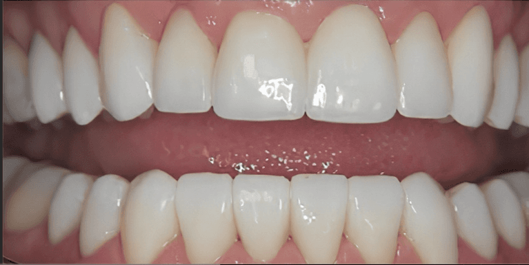 medium_after-case-15