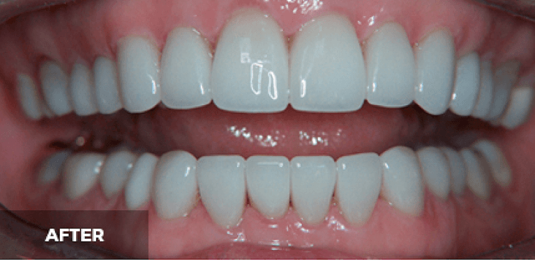 medium_after-case-16