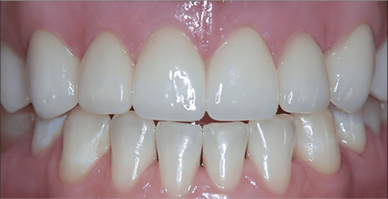 medium_after-case-18