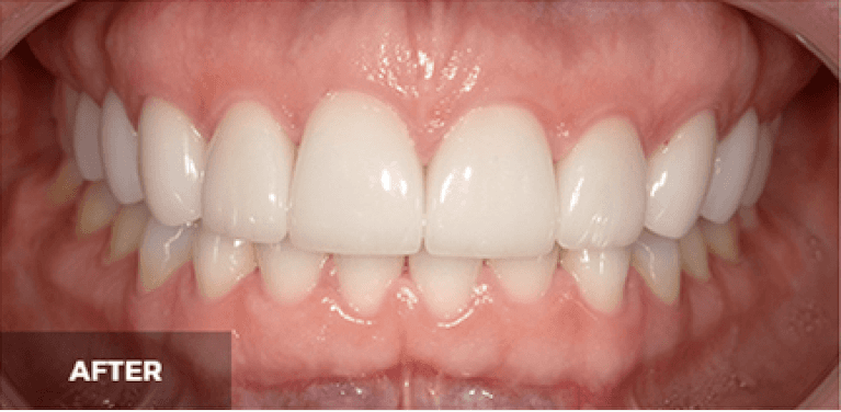 medium_after-case-20 (1)