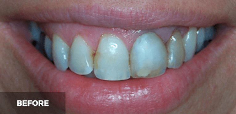 medium_before-case-14