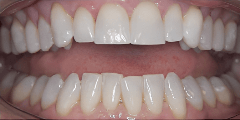 medium_before-case-15