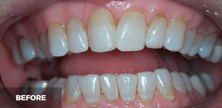 medium_before-case-16