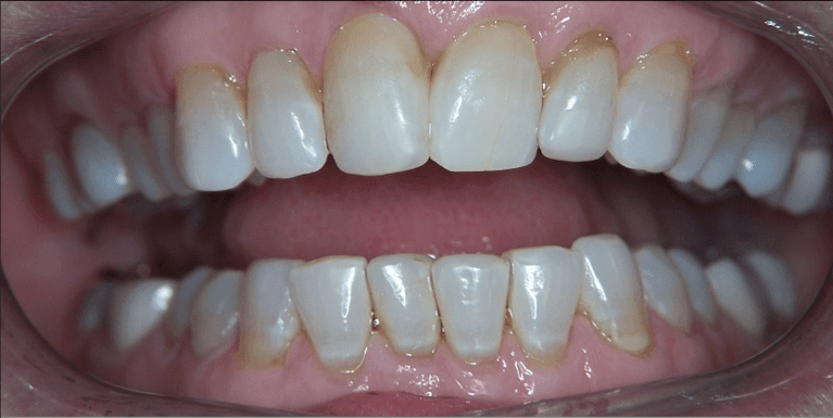 medium_before-case-2