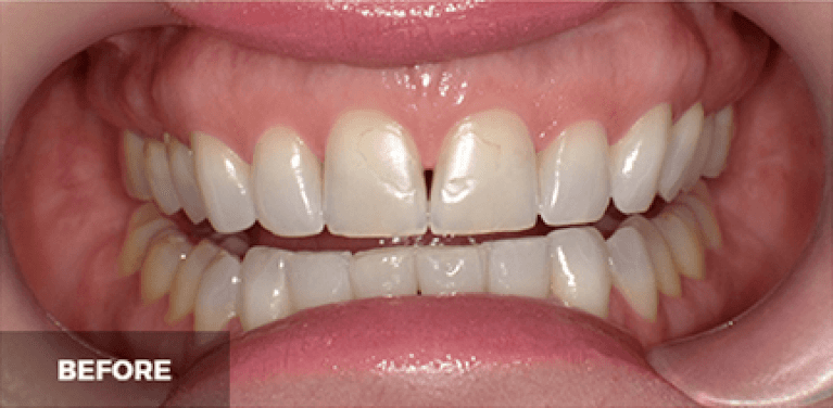 medium_before-case-20 (1)