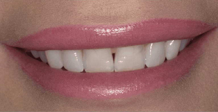 medium_before-case-7